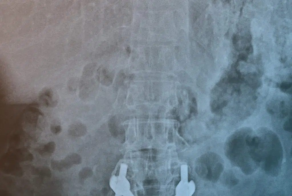 South bay decompression therapy x ray image.