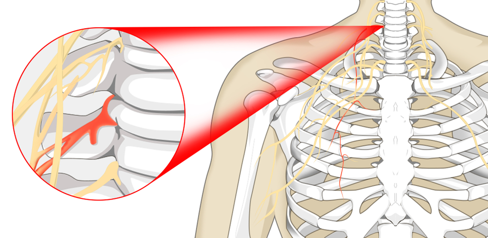 pinched-nerve-treatments-symptoms-chiropractors-zaker-chiropractic