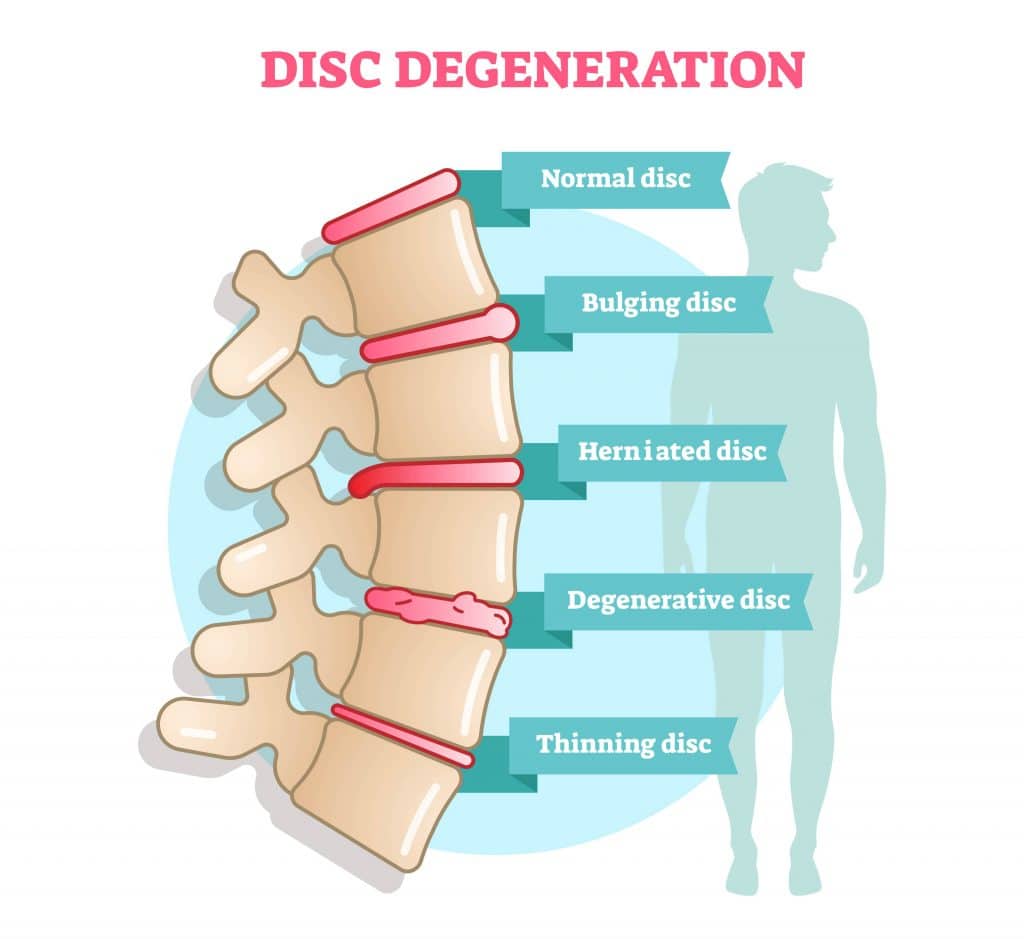 What Can Cause A Bulging Disc In Lower Back