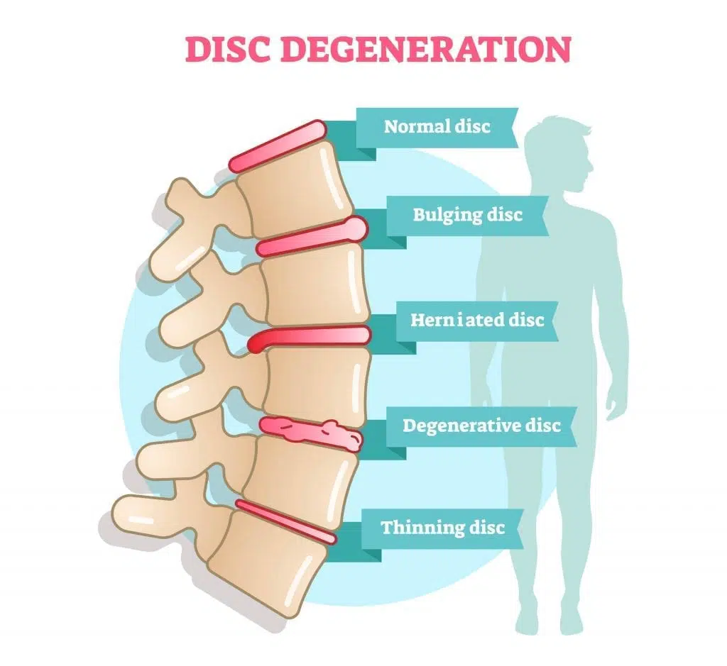 Degenerative Disc Disease Treatment