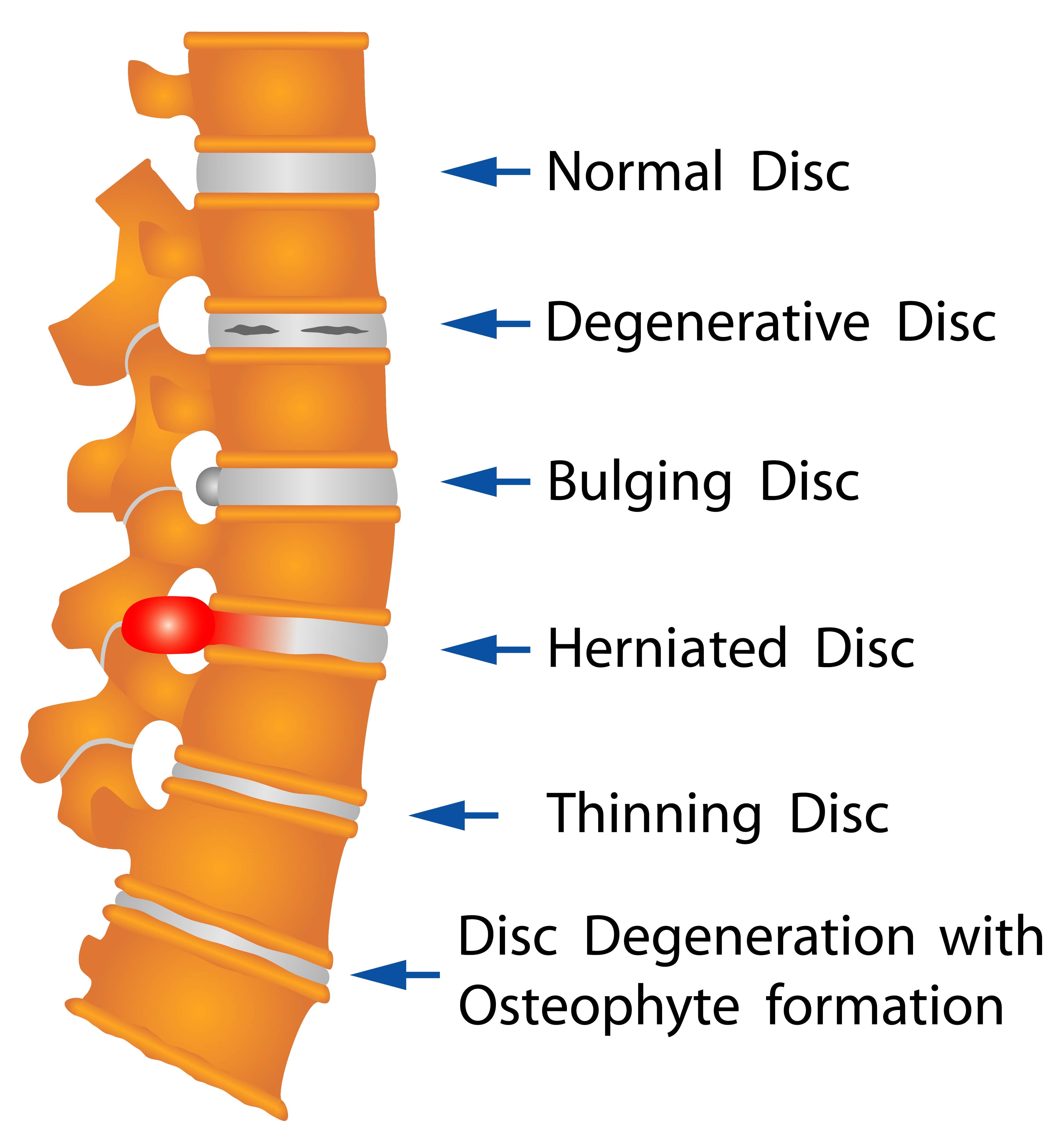 Disc Disorders chart