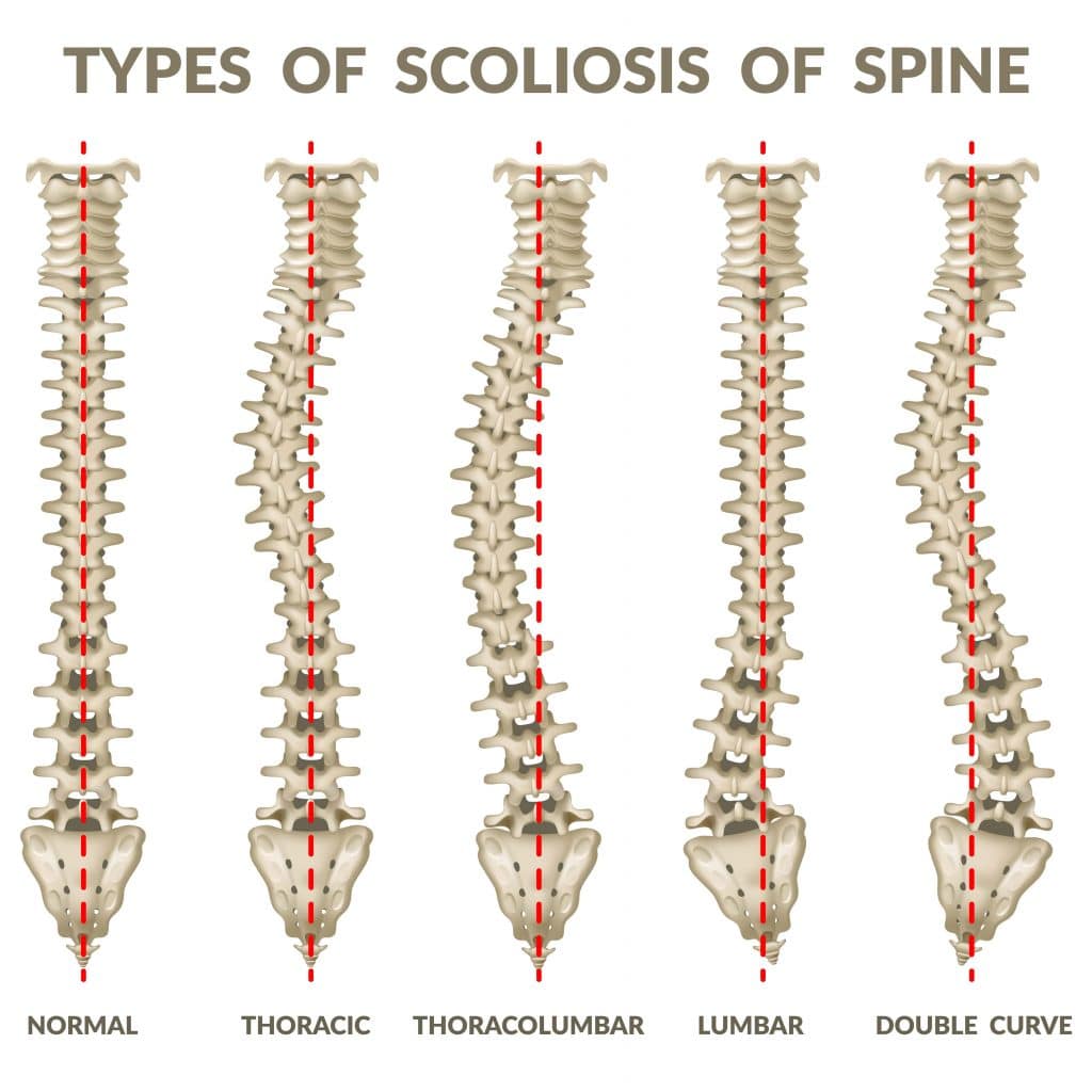 Animation of the types of scoliosis of the spine