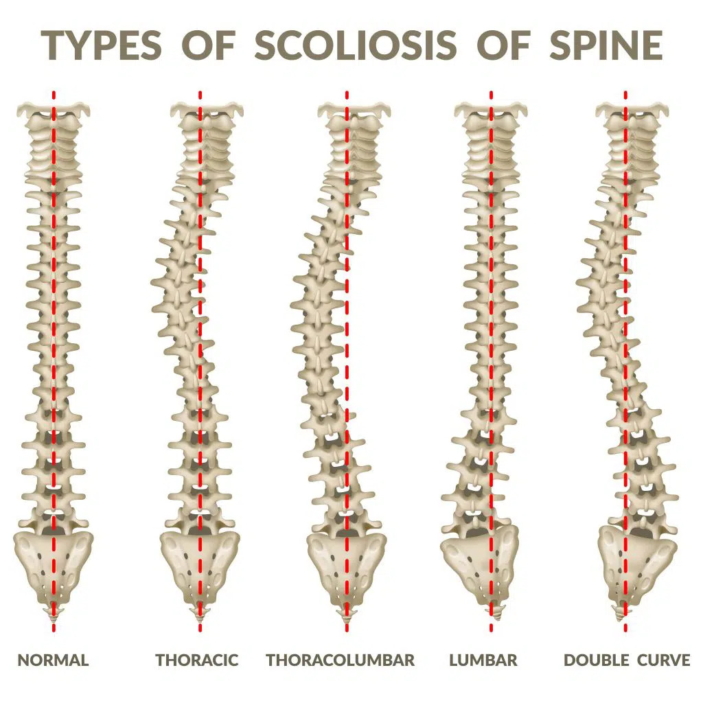 Effective Treatment Options Of Neuromuscular Scoliosis