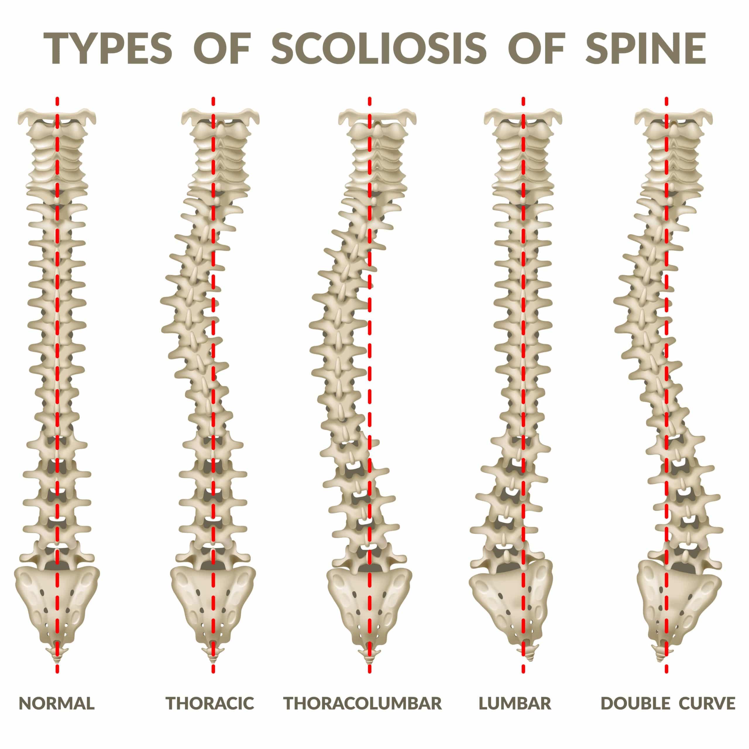 Scoliosis Treatment without Surgery Zaker Chiropractic