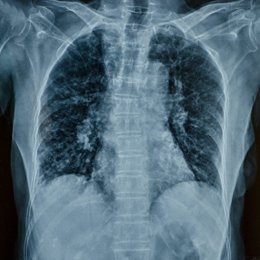 x-ray image of patients back and pelvis