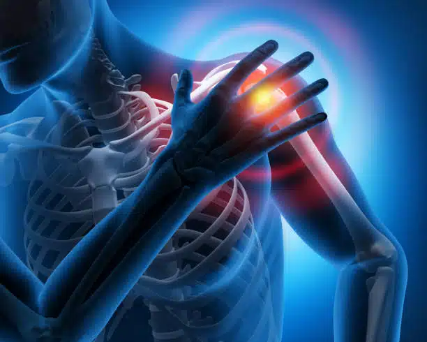 Pain in the Shoulder Joint - Medical Illustration - 3D 