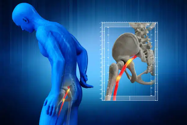 3D medical illustration of a human with a pinched sciatic nerve.