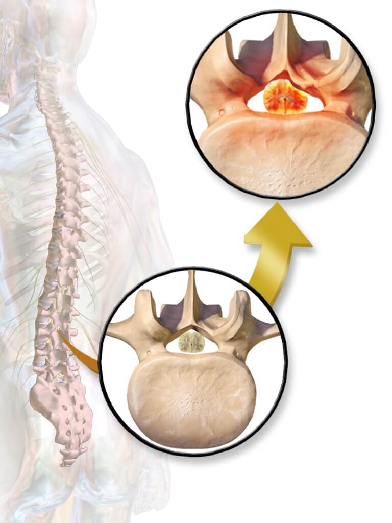 spinal stenosis illustration - decompression therapy concept