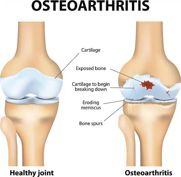 Medical illustration of a joint with Osteoarthritis. 
