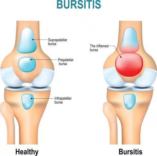 Illustration of knee Bursitis. Healthy human's knee and knee with inflammation of bursae (synovial fluid).