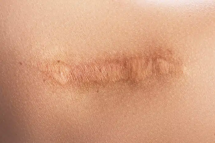 Improved Scar Appearance  after Shockwave Therapy for Scar Tissue Treatment in Torrance
