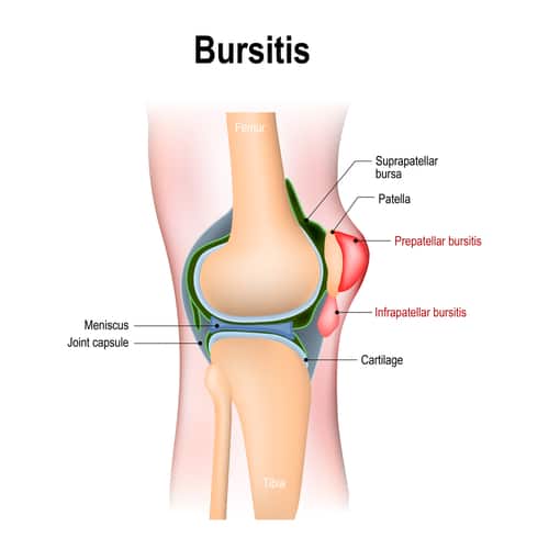 Illustration of knee Bursitis. Healthy human's knee and knee with inflammation of bursae (synovial fluid).